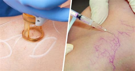 Spider Veins Treatments The Vein Treatment Center