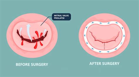 Robotic Mitral Valve Repair Surgery: What Should You Know?