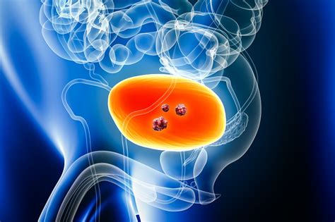 Erdafitinib Shows Promise In High Risk Metastatic Bladder Cancer