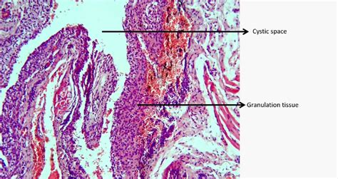 Oral Ranula A Case Report Annoor Dental College Medical Journal