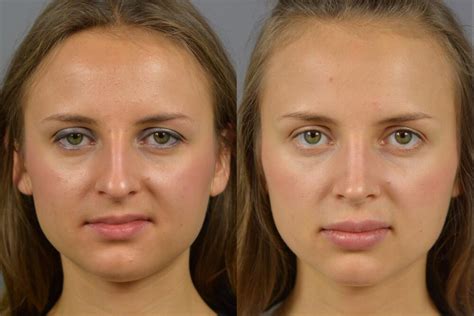 Nose Surgery Before After Long Island Dr Marotta