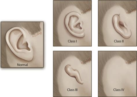 Frontiers Integrated Microtia And Aural Atresia Management