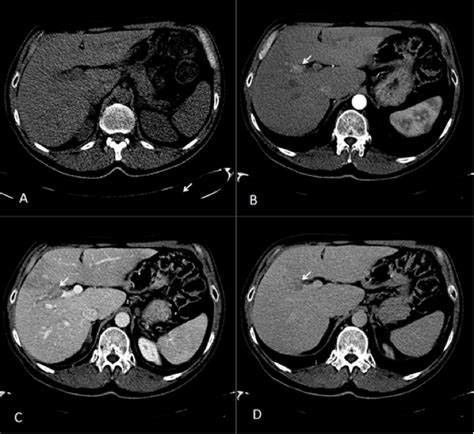 Another portal vein thrombosis? - Frontline Gastroenterology Blog