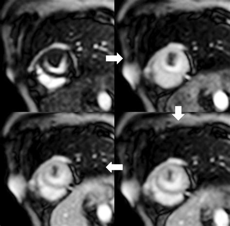 Gd Dtpa First Pass Perfusion Mri In Short Axis View The Lesion Shows