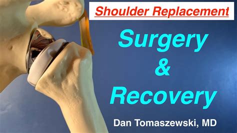 Shoulder Replacement Surgery And Recovery Youtube