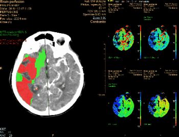 perfusion ct appunti   giovane radiologo