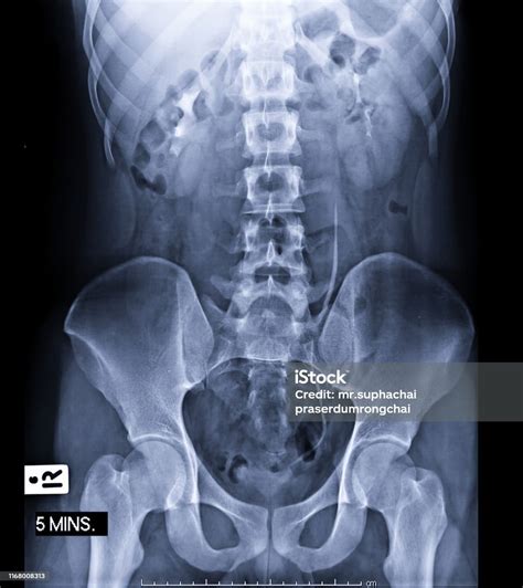 Labeled Abdominal X Ray