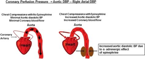 Epinephrine And Coronary Perfusion Pressure Open I