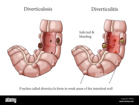 Diagram Diagram Of Diverticulosis Mydiagramonline