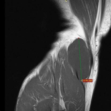 Coronal T2 Weighted Image That Shows A Low Intensity Signal Cyst