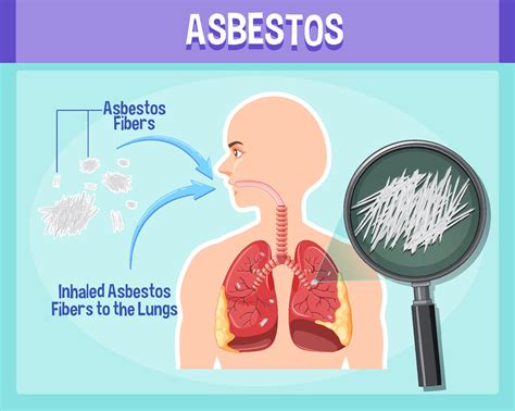 Diagram Showing Asbestosis In Lungs 8191121 Vector Art At Vecteezy