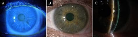 Slit Lamp Photographs Of A Patient With Irregular Astigmatism After