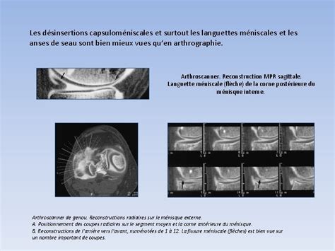 Apport De Larthroscanner Dans La Pathologie Du Genou