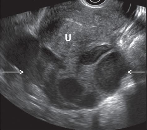 transvaginal  question rultrasound