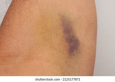 Iv Bruise Images Stock Photos Vectors Shutterstock