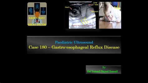 Gastroesophageal Junction Ultrasound