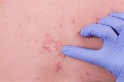 Herpes Simples M Dico Infectologista