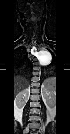 Lateral thoracic meningocele | Radiology Case | Radiopaedia.org