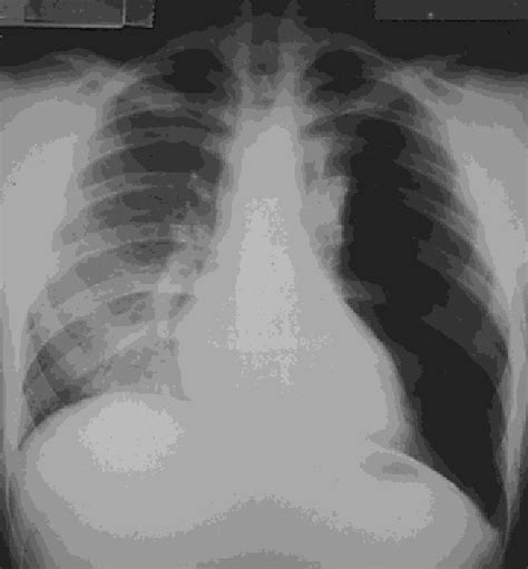 Chest Radiograph Case 2 Showing Giant Bulla In Left Upper Lobe But No