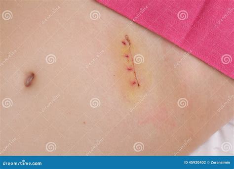 Medicine Appendectomy Surgery Scar Stock Photo Image 45920402