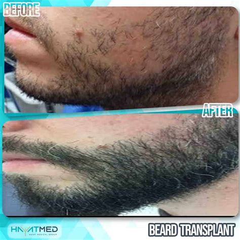 Beard Transplant In Turkey: Best Scarless Results & 2024 Price