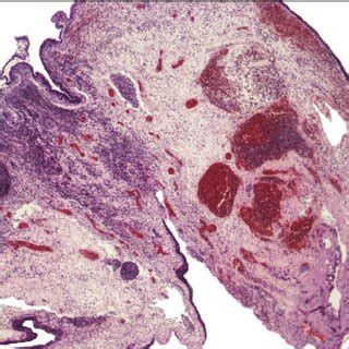 (PDF) Torsion of the testicular appendix: Importance of associated ...