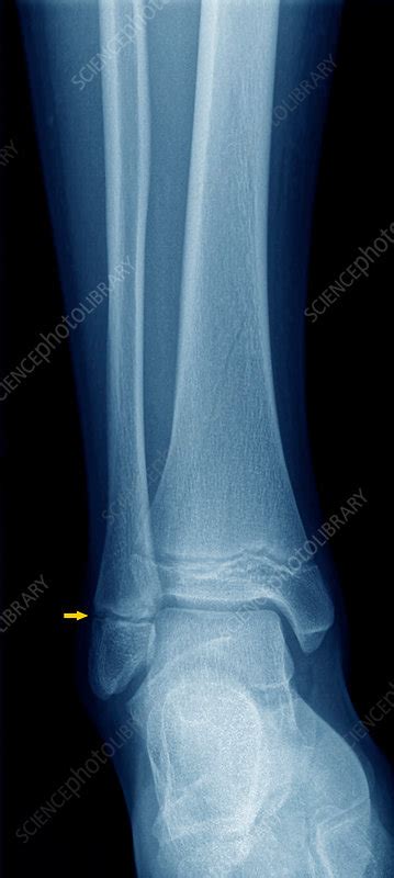 Broken ankle, X-ray - Stock Image - C037/3090 - Science Photo Library