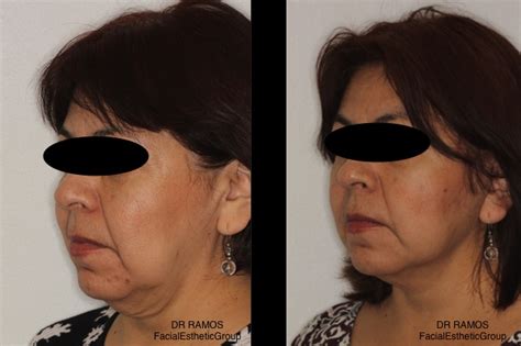 Cirugía Estética Facial Mallorca Lifting cara MACS lift lifting