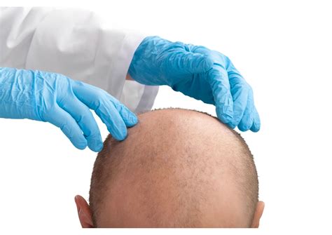 Contraindications Of A Fue Hair Transplant Clinique Du Carr D Or