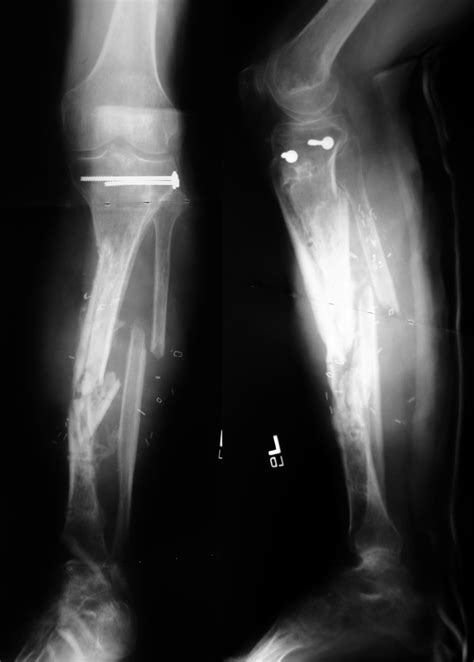 Infected Nonunion: Tibia Case 5 - Dr. Mark Brinker, Houston Orthopedic ...