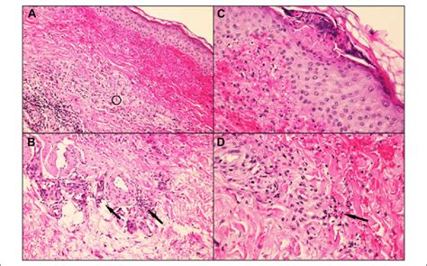 A And B A Biopsy Demonstrating Perivascular Neutrophilic Infiltrate