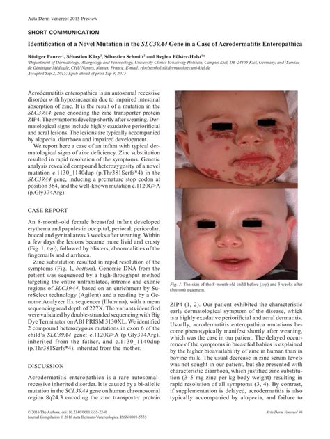 PDF Identification Of A Novel Mutation In The SLC39A4 Gene In A Case