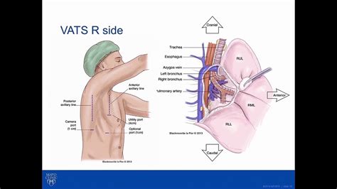 Right Upper Lobectomy Technique