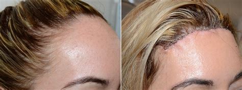 Forehead Reduction Surgery Photos Miami Fl Patient