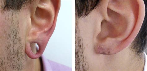 Split Stretched Earlobe Reconstruction Richard Karoo Atelier Yuwa Ciao Jp