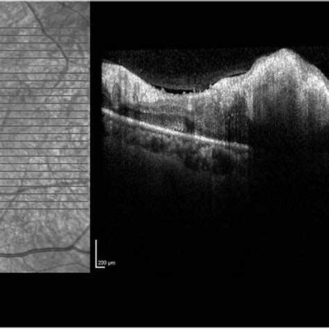 The Full Thickness Appearance Of The Retinal Metastasis Is Seen In Download Scientific Diagram