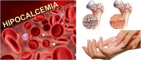 Hipocalcemia Definición Causas Síntomas Diagnóstico Y Tratamiento