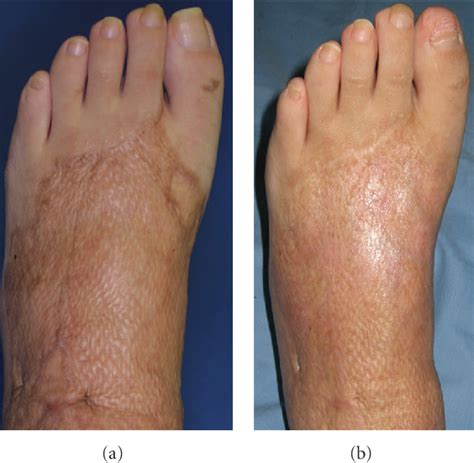 Figure 3 From Treatment Of Mesh Skin Grafted Scars Using A Plasma Skin