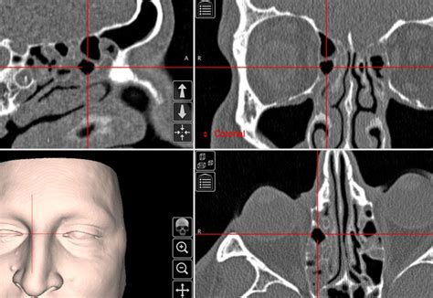 Ct Scan Of A Bulla Ethmoidalis This Cell Sits Above The Horizontal