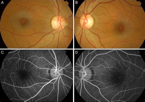 Group A Idiopathic Juxtafoveal Retinal Telangiectasis Case A B