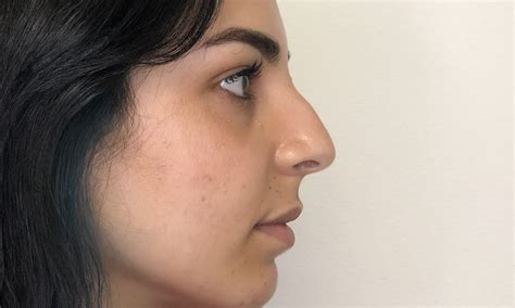 Rhinoplastie Paris Spécialiste chirurgie de preservation Dr J Djian