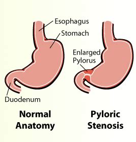 Pyloric Stenosis | UCSF Department of Surgery