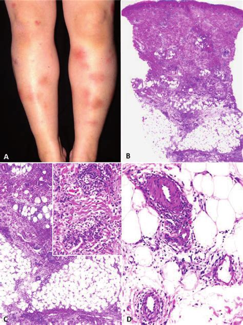 Clinicopathological Features Of An Erythema Nodosum Type Lesion Case Download Scientific