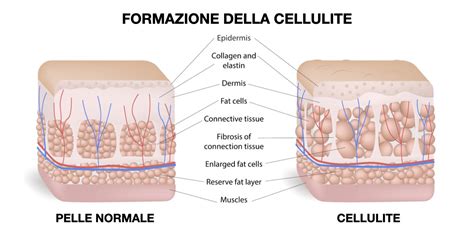 Cellulite E Palestra Allenamento E Stretching Project Invictus