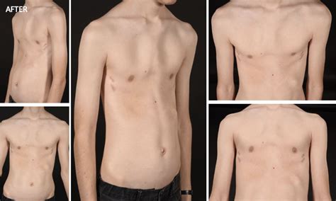 Pectus Excavatum Before And After