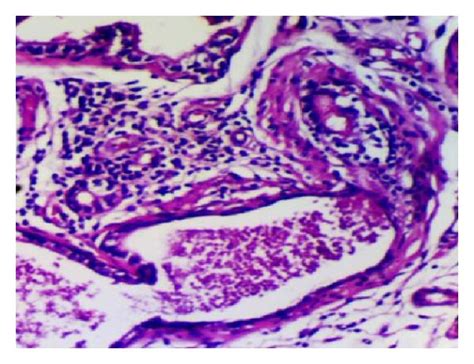 Histological Views Of Prostatic Inflammation In All Groups Normal