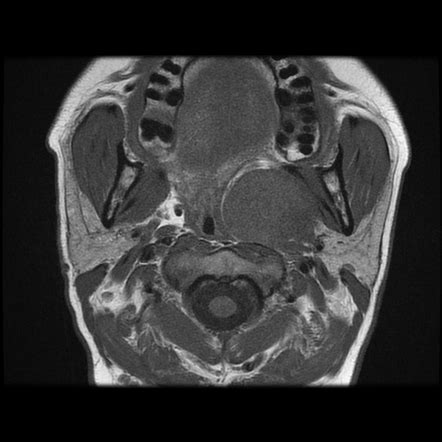 Vagal Schwannoma Image Radiopaedia Org