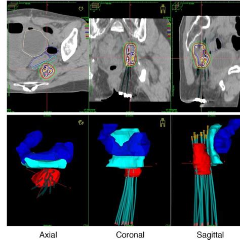 Brachytherapy Treatment Planning Calculated By Plato And Shown In