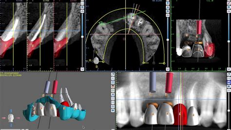 Planificación Digital De Implantes Dentales Munt Espai Dental Youtube