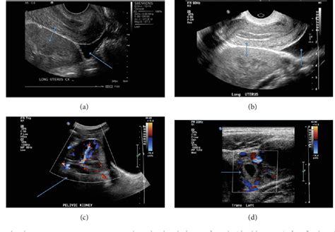 Figure From Successful Laparoscopic Management Of Ruptured Tubal